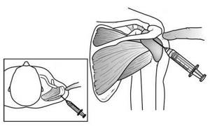 Пункция суставов верхней конечности Пункция плечевого сустава (articulatio humeri).