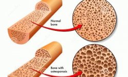 Боли при остеопорозе: локализация, как избавиться