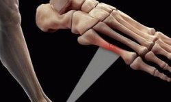Перелом плюсневой кости стопы: виды, признаки и лечение