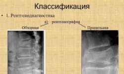 Рентген крестцово подвздошного сочленения