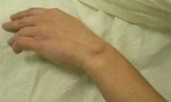 Воспаление суставов кисти руки — причины, лечение