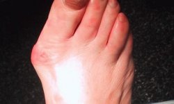 Операция по удалению косточки на большом пальце ноги: отзывы