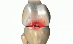 Деформирующий артроз коленного сустава лечение 1 степени