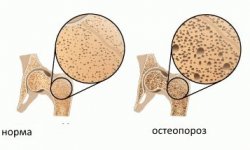 Для предотвращения остеопороза стоит обратить внимание на красный клевер