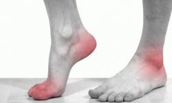 Симптомы подагры на ногах у мужчин и женщин, признаки приступа болезни