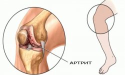 Артрит коленного сустава лечение, разновидности и симптомы