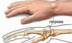 Твердая шишка на запястье руки с внешней стороны сверху под кожей: причины и лечение