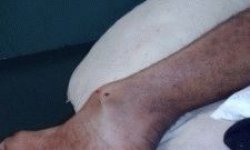 Причины, почему опухают ноги в районе щиколотки: лечение, что делать при ушибах