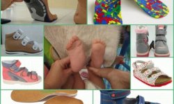 Детская ортопедическая обувь при вальгусной деформации стопы