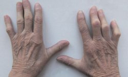 Артрит: лечение в пожилом возрасте, патогенез