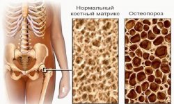 Перелом при остеопорозе: лечение, профилактика