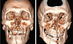 Перелом лобной кости: виды, первая помощь и лечение