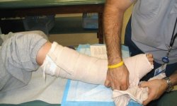 Перелом ноги сколько ходить в гипсе