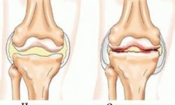 Остеоартроз коленного сустава: причины, симптомы, лечение, степени заболевания, диета