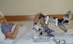 Операция по замене коленного сустава: реабилитация и восстановление