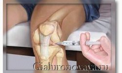 Протез синовиальной жидкости для коленного сустава: препараты