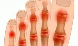 Почему болит палец на ноге (косточки на больших, средних пальцах и суставы)