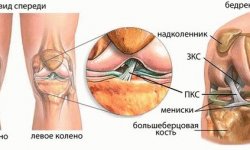 Разрыв передней крестообразной связки: признаки, как лечится