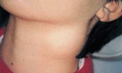 Киста шеи (срединная и боковая): симптомы у взрослых и ребенка, операция