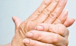 Остеопороз кистей рук: лечение, симптомы, профилактика