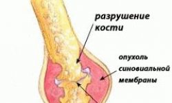 Ревматизм симптоми лікування