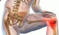 Артроз и артрит нижних конечностей: симптомы и лечение заболеваний суставов