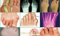 Бурсит пальца ноги: лечение, симптомы, диагностика