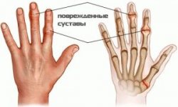 Медикаментозное лечение артрита пальцев рук