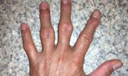 Ревматоиднфй артрит пальцев рук: лечение, симптомы и профилактика