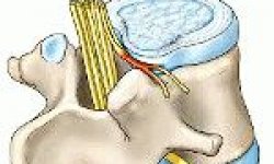 Межпозвоночная грыжа грудного отдела позвоночника: симптомы и лечение