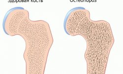 Остеопороз — профилактика, причины появления и способы лечения