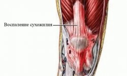 Тендинит коленного сустава: симптомы и методы лечения