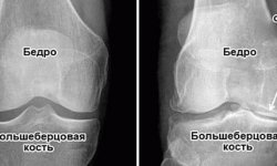 Суставная щель колена: причины сужения, лечение