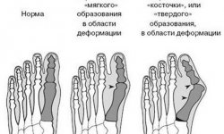 Упражнения от косточки на большом пальце ноги