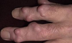 Гигрома пальца руки: лечение, причины и симптомы