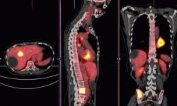 ПЭТ КТ: что это за процедура и для чего она проводится