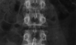 Информативность рентгена при остеохондрозе шейного отдела