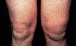 Воспаление коленного сустава (в том числе мениска): лечение, симптомы и причины