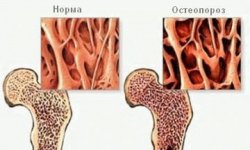 Ростовчанам предлагается экспресс-диагностика остеопороза