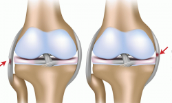 Вопрос травматологу: нужна ли операция после травмы колена?