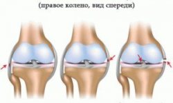 Лечение связок и сухожилий коленного сустава