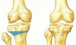 Остеотомия коленного сустава: реабилитация, последствия