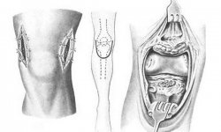 Артротомия суставов: показания, осложнения, виды