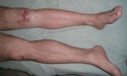 Остеомиелит коленного сустава: последствия, профилактика