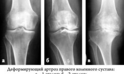 Гонартроз коленного сустава: степени, лечение, инвалидность