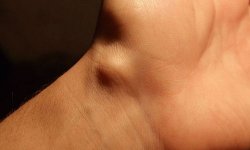 Гигрома на запястье руки: лечение, симптомы, причины