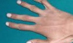 Арахнодактилия (синдром паучьих пальцев) — симптомы, лечение и фото