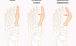 Косточка на ноге: лечение, причины возникновения, профилактика