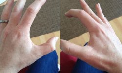 Почему дергается большой палец на левой или правой руке, причины