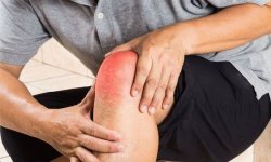 Гнойный артрит в коленном и голеностопном суставе